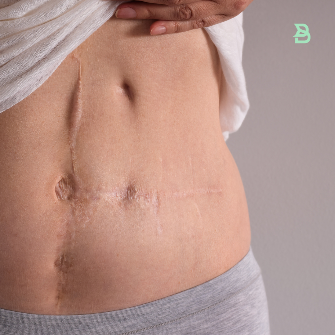 CO2 Cicatrices por accidente (Abdomen)