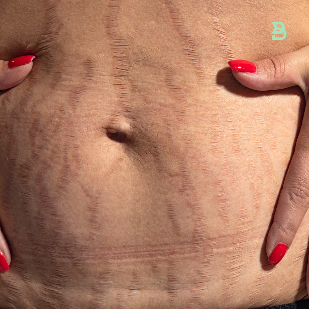 CO2 en Estrías (Abdomen)
