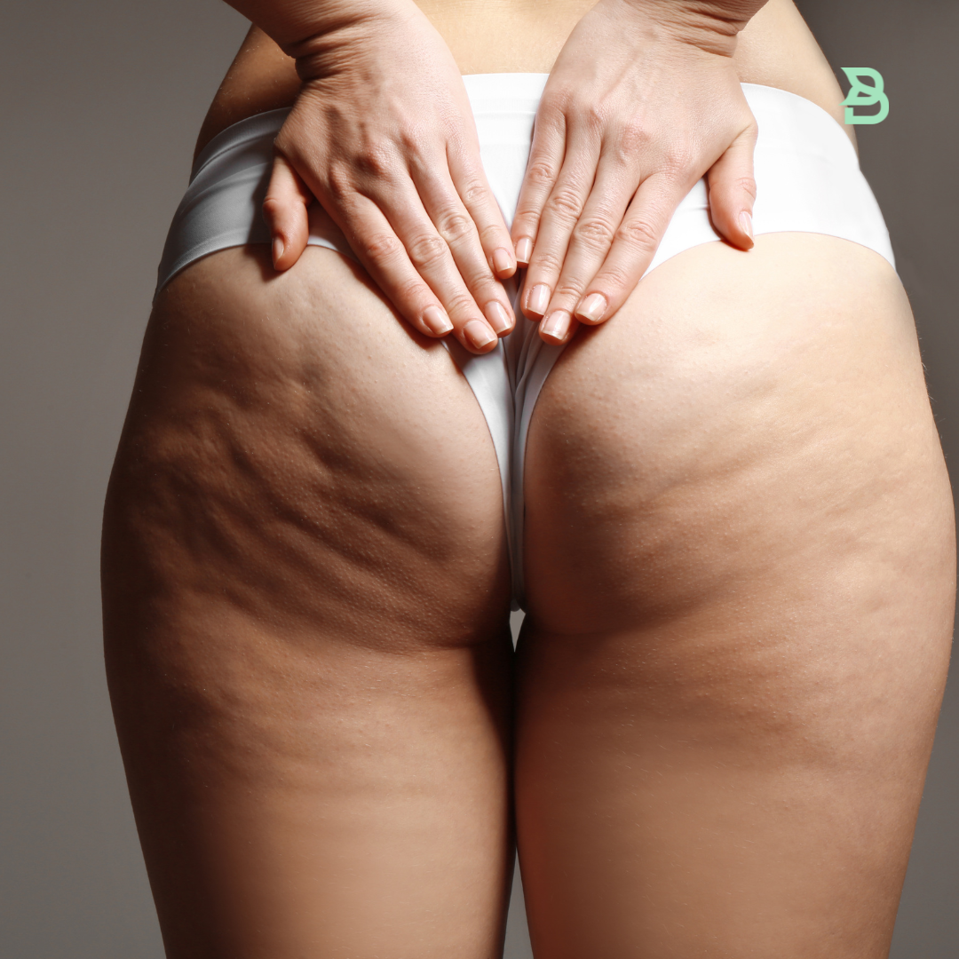 Anticelulitis en glúteo + piernas