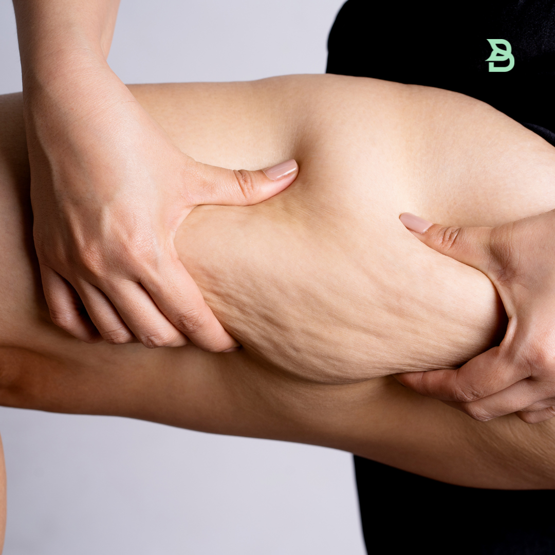Anticelulitis en piernas