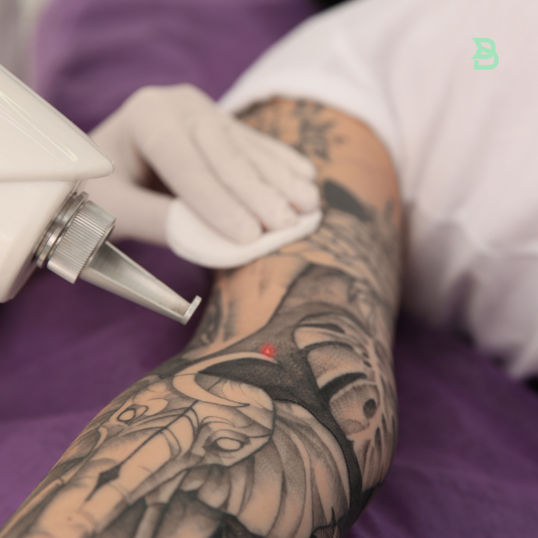 Remoción de tatuajes